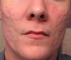 acne scars on the skin of man (over 40 years old) Best Acne Scar Removal, Acne Scar Removal Cream