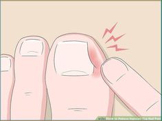 Get rid of ingrown toenails naturally with these home remedies. Prevent ingrown toenails from recurring by trimming your nails straight across and wearing shoes that fit #Toenail_Pain #Nail_Remedies #Infected_Toenail #Nail_Infection | Toenail Pain, Infected Toenail, Nail Remedies, Nail Infection, Ingrown Toenail, Ingrown Nail, Fungal Nail, Ingrown Toe Nail, Brittle Nails Nails Remedies, Toenail Pain, Toe Nail Fungal Infection, Infected Toenail, Nail Fungus Remedies, Diy Nail Care, Nail Remedies, Toenail Fungus Remedies, Nail Fungus Remedy