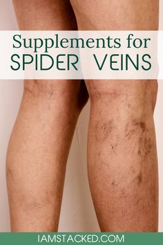 Vein Health, Leg Veins, Venous Insufficiency, Medical Procedures, Compression Stockings, Best Supplements, Lifestyle Changes