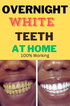 Smile with Confidence: Turmeric Toothpaste for Brilliant Teeth White Teeth Tips, Teeth Tips, Whiten Teeth Fast, Teeth Whitening Methods, Whitening Teeth