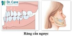 Khớp cắn ngược là gì? Nguyên nhân và cách điều trị | Dr. Care Dental Lab Technician, Zoom Teeth Whitening, Human Body Unit, Dental Anatomy, Premature Birth, Dental Life, Kundalini Awakening, Dental Laboratory, Dental School