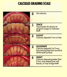 Calculus Grading Scacle #calculus #tartar #dental Dental World, Grading Scale, Dental Anatomy, Dental Fun