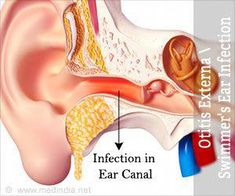 Otitis externa, also commonly referred as Swimmer Yoga Information, Feminine Health, Hygiene Routine, Hormone Health, Healthy Diet Plans, Sleep Deprivation