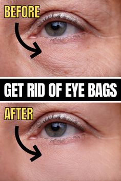 Get Rid Of Eye Bags, Rid Of Eye Bags, Eye Bag Remedies, Puffy Eyes Remedy, Wrinkles Remedies Face, Saggy Neck, Dark Eye Circles, Natural Skin Care Remedies, Under Eye Wrinkles