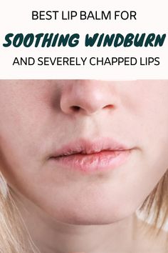 Windburn on lips is a common annoyance during frigid, cold winter months. Exposure to harsh, dry winds can lead to red, cracked, swollen, peeling lips that sting and hurt something fierce. This painful chapping and scaling is often aggravated by constantly licking lips in an attempt to moisturize them. Finding the right nourishing balm is key to both treating and preventing windburn while saving your pout. Swollen Lips, Get Rid Of Wrinkles, Wrinkle Remedies, Flaking Skin, Best Lip Balm, Chamomile Essential Oil, Cracked Skin, Peeling Skin, Flaky Skin