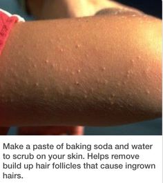 Obličejové Masky, Clear Skin Tips, Beauty Remedies, Diy Beauty Hacks, Skin Care Solutions, Ingrown Hair, Healthy Skin Care