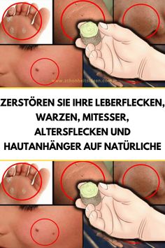 Zerstören Sie Ihre Leberflecken, Warzen, Mitesser, Altersflecken und Hautanhänger auf natürliche Health Department, Cosmetic Surgery, Skin Problems, Keto Diet Recipes, Get In Shape, Beauty Make Up, Health And Beauty, Beauty Hacks, Health