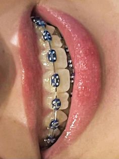 Cute braces | Perfect teeth | Getting braces | Dental braces | Braces colors | Cute braces colors Braces Cute, Gif Birthday, Braces Smile