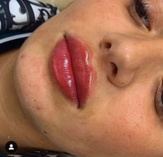 Lip Fillers 1ml, M Shaped Lips, Chin Filler, Cheek Fillers, Facial Contouring, Perfect Nose