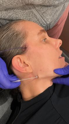 Everything You Need to Know About Thread Lifts | Who What Wear UK Thread Lift Face Before And After, Lower Face Lift Before And After, Pdo Thread Lift Before And After, Thread Face Lift, Lower Face Lift, Thread Lift Face, Esthetics Business, Neck Lift Surgery, Castor Oil For Face