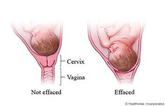 #4- Another view of Effacement Pregnant Anatomy, Cervical Effacement, Dilation And Effacement, Birth Classes, Cervical Dilation, Signs Of Labor, False Labor, Medical Illustrations