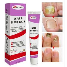 Pain-free Gel: No need to cut infected nails.It is a gentle, side-effect free external application. Nail repair cream, at the same time and gives the nails natural shine and helps the nails smooth and revive. Quick Effection: Only 1 week for significant improvement! With continuous use, it completely cares nail and regrow healthy nails generally within 3-4 weeks! toe be health instant beauty gel, multi-purpose nail repair. 24h Hydration: Provide hydration and gently smooth the outer layers of th Improve Appearance, Cracked Nails, Manuka Oil, Antifungal Cream, Foot Nail, Nail Infection, Fungal Nail, Nails Natural, Nail Repair