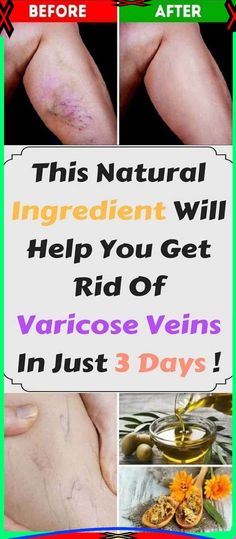 Varicose Vein Removal, Varicose Vein Remedy, Vein Removal, Color Psychology, Natural Home Remedies, Health Matters, Good Night Quotes