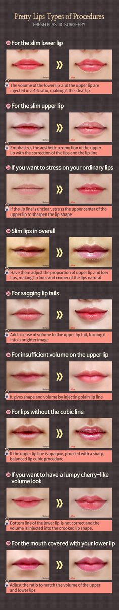 Lip Injections Juvederm, Rhinoplasty Nose Jobs, Lip Types, Botox Lips, Botox Cosmetic, Esthetician Room