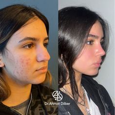 #plasticsurgery #plasticsurgerygonewrong #beforeafter #celebritiesbeforeafter #hollywoodstars #bignosesurgery #surgery #facesurgery #vlinesurgery #koreanplasticsurgery #kpopplasticsurgery #nosejob #jawreductionsurgery #eyesurgery #cheekfillers #rhinoplasty #facelift #plasticsurgeryfails #expensiveplasticsurgery #fails Beauty Job