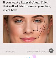 Natural Cheek Filler, Medspa Office, Cheek Injections, Botox Migraine, Face Plastic Surgery, Esthetician Inspiration, Aesthetic Nurse