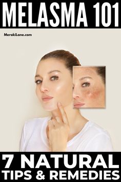 Often called the mask of pregnancy, melasma is a common condition that can be embarrassing. Here are 7 natural melasma remedies to try! Foods High In Vitamin D, Diy Turmeric Face Mask, Turmeric Face, Baby Feeding Schedule, Turmeric Face Mask, Ginger Smoothie, Red Lentils, Remove Dark Circles, Home Health Remedies