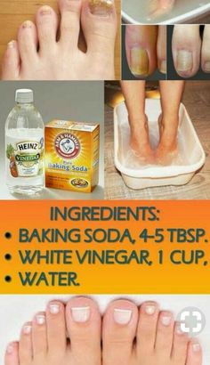 Listerine & Vinegar Foot Miracle Soak Recipe for Toenail Fungus, Dead Skin, Calluses & Cracked Hee Dry Feet Remedies, Foot Soak Recipe, Natural Skin Care Remedies, Baking Soda Shampoo, Beauty Remedies, Skin Care Remedies, Natural Health Remedies, Healthy Skin Care