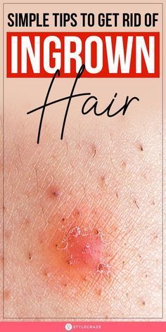 Infected Ingrown Hair, Treat Ingrown Hair, Ingrown Hair Remedies, Bump Hairstyles, Ingrown Hair Removal, Hair Curl, Underarm Hair Removal, Prevent Ingrown Hairs, Ingrown Hairs