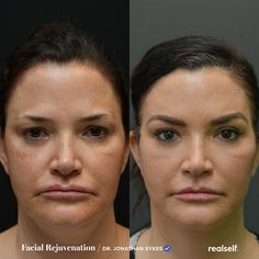 Eyebrow Lift Before And After, Temporal Brow Lift, Eye Brow Lift Before And After, Brow Lift Before And After, Eyebrow Lift Surgery, Eyebrow Lift Botox Before And After, Eye Brow Lift, Endoscopic Brow Lift Before And After