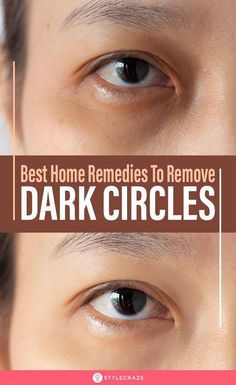 Dark circles under eyes can be a problem, especially if they are persistent. Read on to know more about this issue and how you can treat them naturally at home. Remedies For Dark Circles, Dark Circle Remedies, Dark Circles Around Eyes, Dark Eye Circles, Remove Dark Circles, Under Eyes, Dark Circles Under Eyes, Dark Circle, Beauty Remedies