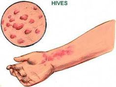 Hives is allergic reaction that is release of histamines. Need to find trigger and treat naturally with Vitamin B-12, vitamin C, Quercetin, elimination diet. Natural Remedies For Hives, Hives Causes, Hives Remedies, Low Histamine Diet, Home Remedies For Skin, Cold Remedies, Natural Home Remedies