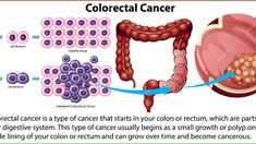 Colon Cancer Symptoms: What You Need to Kn Pascal Wallpaper, When To Plant Vegetables, Lack Of Energy, Healthy Routine, Black And White Decor, Pedro Pascal, Digestive System