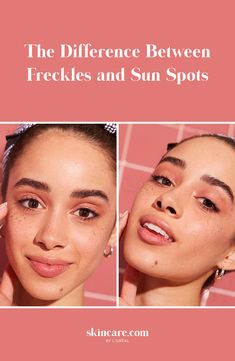 With the excessive amounts of time spent in the sun recently, it can be difficult to differentiate between freckles and sun spots. Both of these pigmented spots tend to appear after too much sun exposure, yet they're inherently different. Learn the truth about your own skin and avoid any future sun damage with the tips in our article! #summerskin #sunspots #freckles #skinbeauty #summerbeauty Sun Freckles, Sunspots On Face, Sun Spot, Skincare Advice, Dark Under Eye, Summer Skin, Skin Discoloration, Sun Exposure