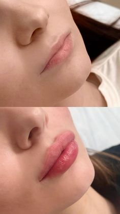 Lip Filler 1 Ml, Top Lip Filler, 1 Ml Lip Filler, Juvederm Lips, Lips Fillers