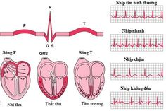 Bệnh tim thiếu máu cục bộ mạn tính: Những điều cần biết | Vinmec Respiratory Therapy, Heart Rhythms, Nursing School Notes