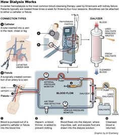 How dialysis works Nursing Information, Critical Care Nursing, Respiratory Therapy, Juicy Lips, Nursing Notes