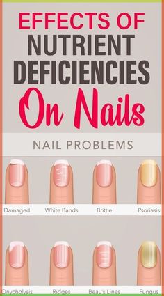 Nail Health Signs, Nail Problems, Vitamin Deficiency, Magnesium Deficiency, Nutrient Deficiency