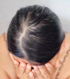 Diffuse Hair Loss: Causes, Signs and Treatment Options Diffuse Hair, Alopecia Causes, Regrow Thinning Hair, Alopecia Treatment, Androgenic Alopecia, Androgenetic Alopecia, Aesthetic Birthday, Birthday Pics, Thin Hair Haircuts