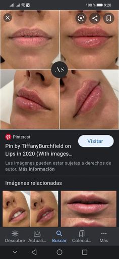 Lip Injections Shapes Before And After, Lip Flip And Filler Before And After, Lip Filler Inspo Heart Shape, Lip Fillers Shapes Natural, Before And After Lip Flip, Lipfiller Before After, Lip Filler Before And After Juvederm, 1ml Lip Filler Before And After, Natural Lip Fillers Before And After