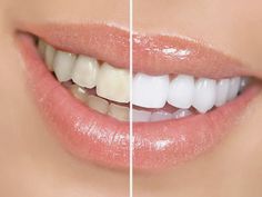 Baking Soda Teeth, Baking Soda Teeth Whitening, Teeth Whitening Homemade, Teeth Whitening Remedies, Laser Teeth Whitening, Charcoal Teeth Whitening, Perfect Teeth, Overnight Beauty, Teeth Whitening Pen