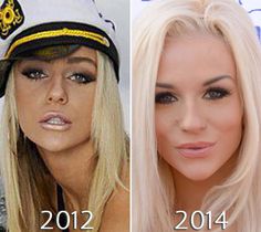 before and after photos of the same woman's face in different stages of plastic surgery