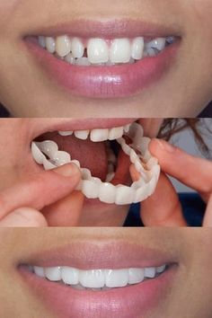 Snap On Smile (par) Inferior E Superior Snap On Smile, Partial Dentures, Permanent Cosmetics, Dental Laboratory, Dental Veneers, Smile Teeth, Dental Procedures, Natural Teeth, Dentures