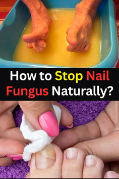 This natural recipe might stop toenail fungus naturally: ozonized sunflower oil, tea tree oil, garlic, and kerasal. #fungus #nailfungus #toenailfungus #homeremedy #healthynails Nails Olive, Toenail Health, Nail Fungus Remedy, Proper Hygiene, Toenail Fungus, Nail Fungus, Homemade Remedies, Nail Health