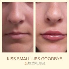 Small Lips Filler, Lip Filler Small Mouth, Subtle Lip Filler, Lips Reference, Aesthetic Dermatology