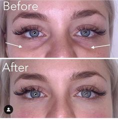 Tear Trough Filler, Eye Lift Surgery, Dark Under Eye Circles, Bags Under Eyes, Sunken Eyes, Under Eye Circles, Under Eye Makeup