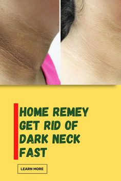 How to take the black off your neck Get Rid Of Dark Neck, How To Take