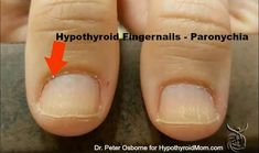 Do you have hypothyroidism? Look at your hands | Hypothyroid Mom White Spots On Nails, Low Thyroid, Thyroid Symptoms, Thyroid Issues, Thyroid Gland, Thyroid Hormone, Thyroid Health, Adrenal Fatigue, Hormone Health