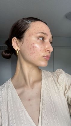 Acne prone & glowy skin Acne Photos, Skin Care Hyperpigmentation, Skincare Science, Face Mapping Acne, Acne Hyperpigmentation, Acne Prone Skin Care, Acne Makeup, Facial Tips, Acne Treatments