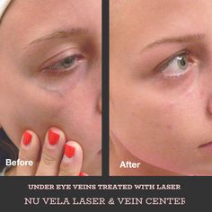 Under Eye Vein Removal, Eye Veins Makeup, Face Veins, Eye Veins, Eye Makeup Halloween, Veins Makeup, Facial Veins, Thread Veins