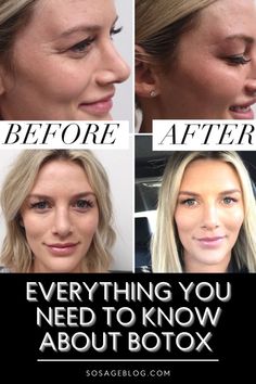 Botox Dos And Donts, Botox In Chin, Botox Eye Lift, Botox Brow Lift Injection Site, Lip Botox Before And After, Botox Around Eyes, Latisse Before And After, Botox Face Lift