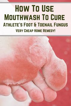 How To Use Mouthwash, Foot Fungus Remedies, Warts Remedy, Toenail Fungus Remedies, Shtf Preparedness, Elder Care, Losing 40 Pounds, Health Hacks