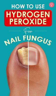 Fungal Infection Remedies, Toenail Health, Toenail Fungal Infection, Nail Remedies, Peroxide Uses, Toenail Fungus Remedies, Nail Fungus Remedy, Fungal Nail, Toenail Fungus