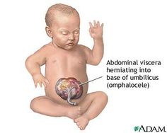 Chromosomal Abnormalities, Nursing Information, Gestational Age, Heart Defect, Create Picture, Medical Knowledge, Nclex