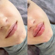 Изменение формы губ при помощи 1,1 мл препарата #repinaolya_003 Lip Flip, Lips Inspiration, Lip Combos, Facial Fillers, Lip Filler, Lip Fillers, Group Chat, Surgery, Blossom