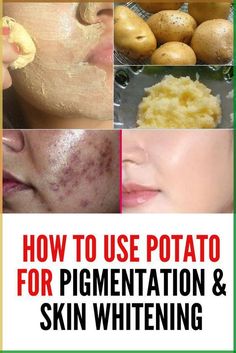 Yes, you can reduce dark sports at home. But you should know about this best home remedies for pigmentation that will make your skin spotless Bronze Makeup Look, Natural Makeup Tips, Home Remedies For Skin, Forehead Wrinkles, Different Skin Tones, Acne Care, Cruelty Free Skin Care, Easy Family Meals